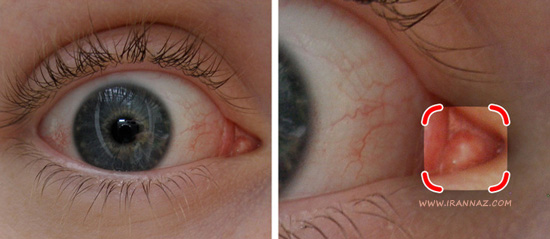 قسمت صورتی رنگ گوشه چشم ها ، کارهای عجیب بدن انسان