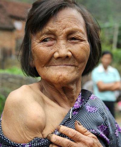 بیماری عجیب در میان افراد روستایی در چین (عکس)