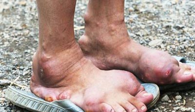 بیماری عجیب در میان افراد روستایی در چین (عکس)