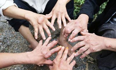 بیماری عجیب در میان افراد روستایی در چین (عکس)