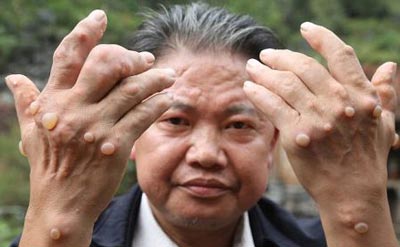 بیماری عجیب در میان افراد روستایی در چین (عکس)