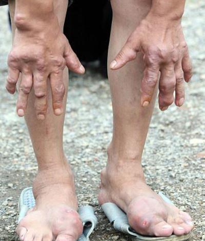 بیماری عجیب در میان افراد روستایی در چین (عکس)