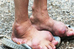 بیماری عجیب در میان افراد روستایی در چین (عکس)