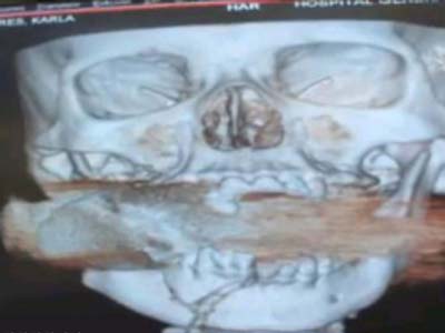 خارج کردن نارنجک منفجر نشده از صورت زنی +عکس