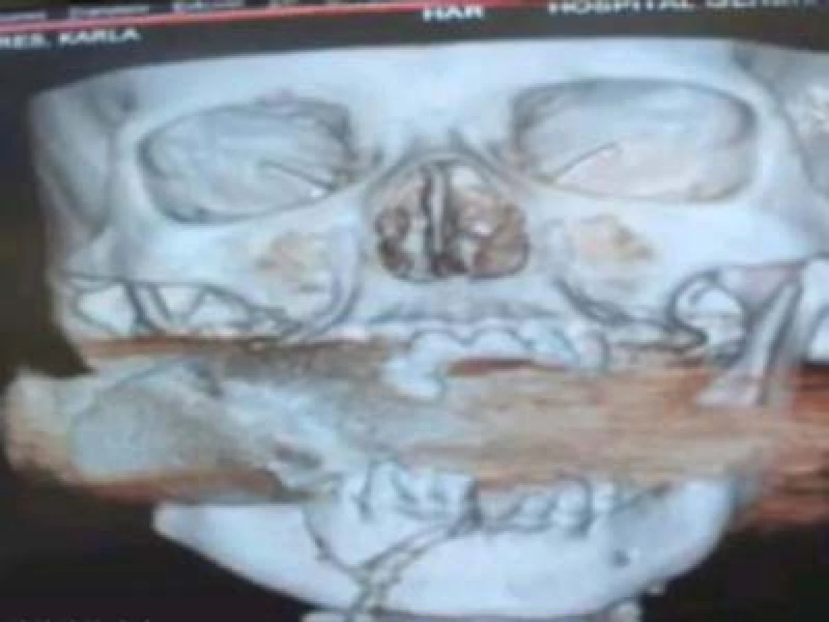 خارج کردن نارنجک منفجر نشده از صورت زنی +عکس