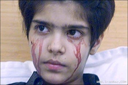دختر 14 ساله و عجیبی که خون گریه می‌کند +تصاویر