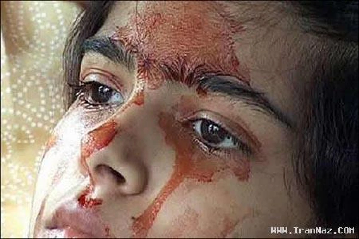 دختر 14 ساله و عجیبی که خون گریه می‌کند +تصاویر