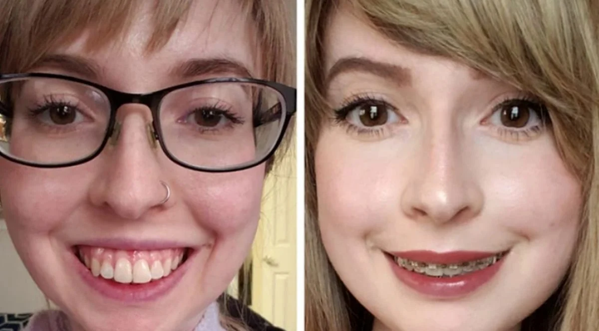 تاریخ عکس گردی| نتیجه ۲۰ جراحی که این زنان را به آرزویشان رساند