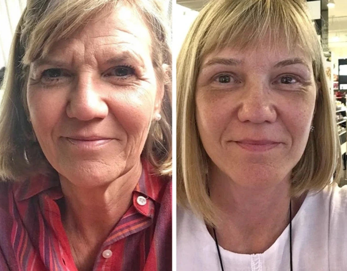 تاریخ عکس گردی| نتیجه ۲۰ جراحی که این زنان را به آرزویشان رساند