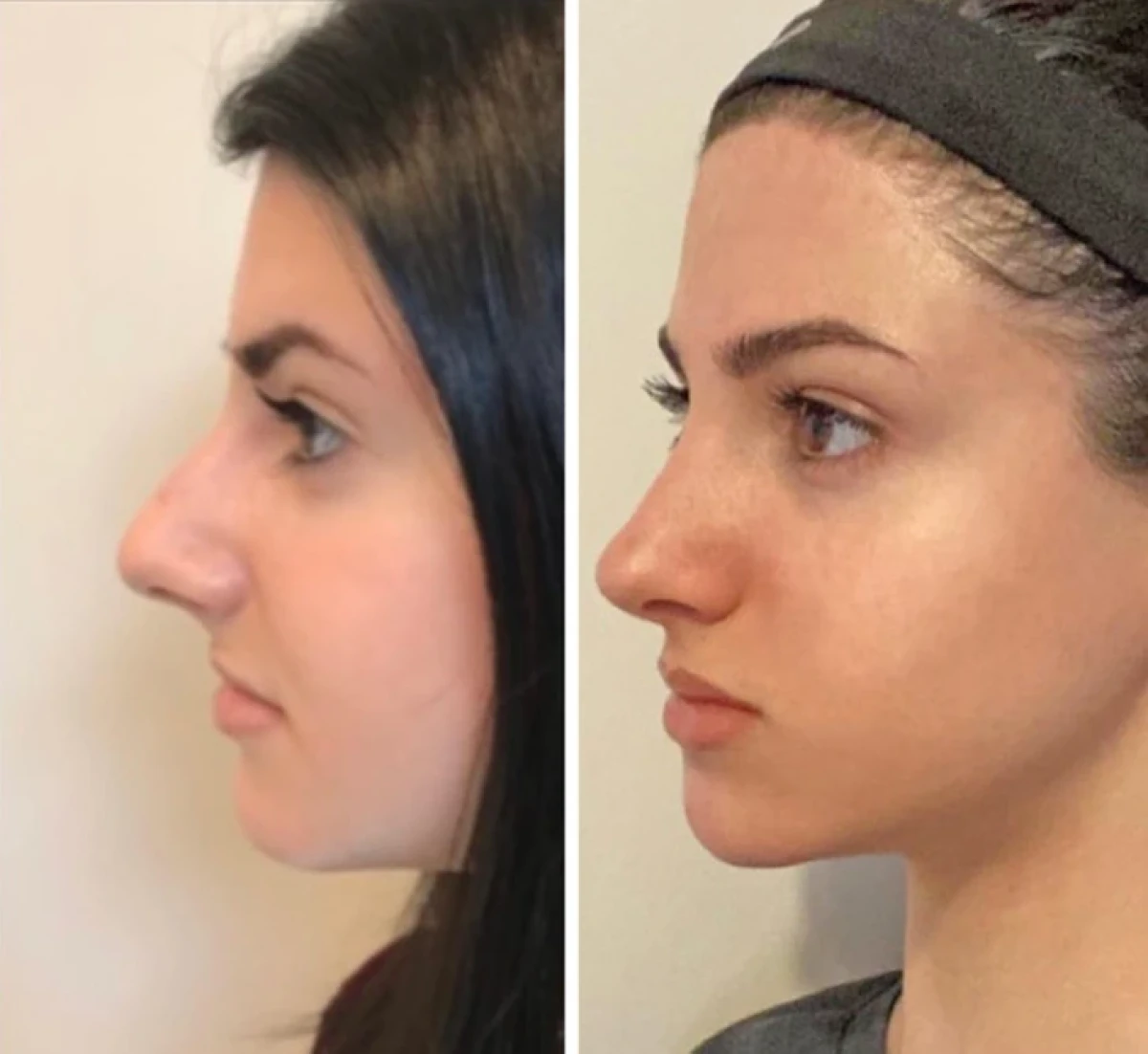 تاریخ عکس گردی| نتیجه ۲۰ جراحی که این زنان را به آرزویشان رساند