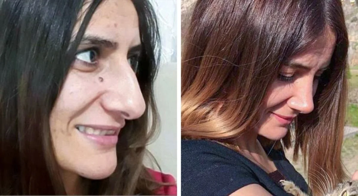 تاریخ عکس گردی| نتیجه ۲۰ جراحی که این زنان را به آرزویشان رساند