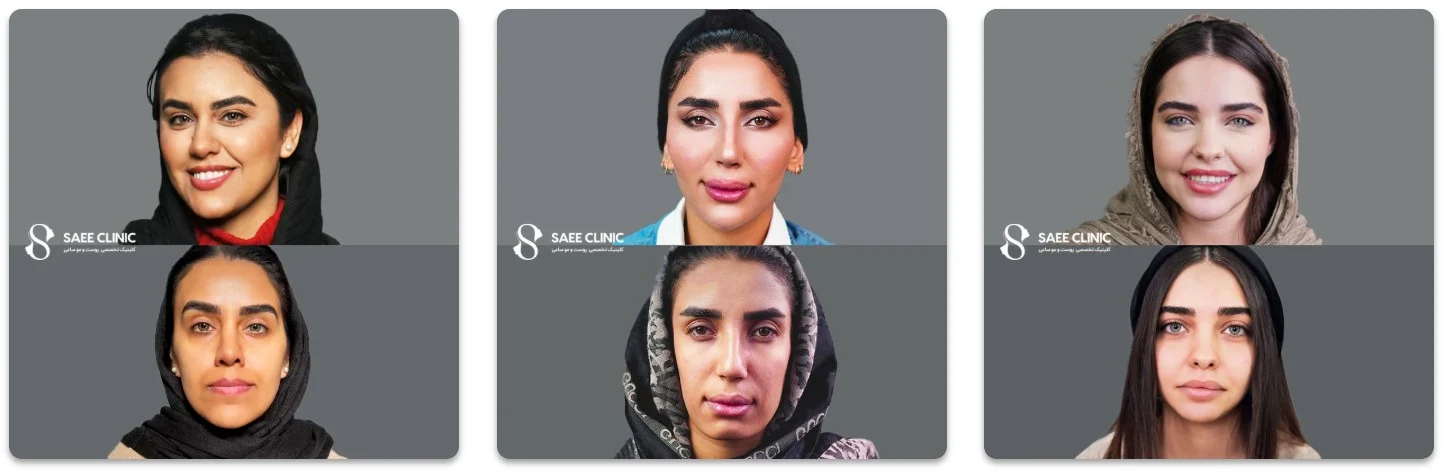 نگاه امروز | ماندگاری کانتورینگ صورت با فیلر چقدر است؟