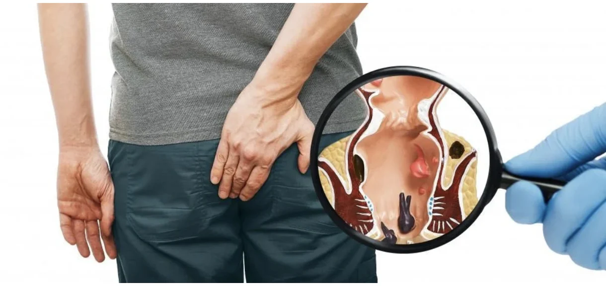 2025-12-02_14-12-18_742230-meylesokhan-ir درمان فوری بواسیر، شقاق و فیستول بدون بیهوشی؛ روشهای نوین ۱۴۰۴