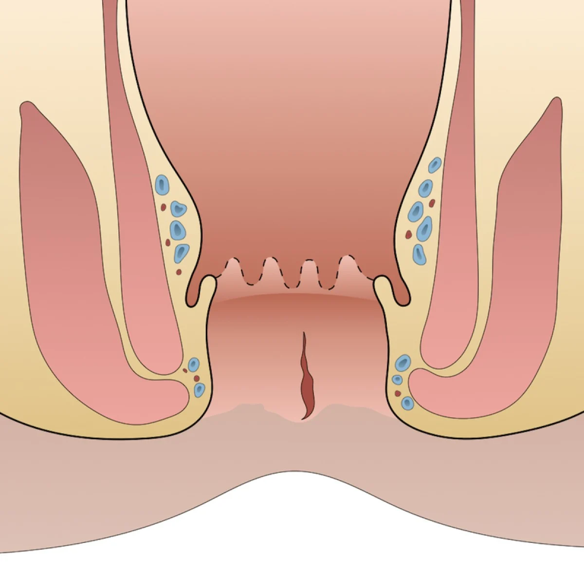 2025-12-02_14-12-19_465554-meylesokhan-ir عوارض شقاق مقعد (فیشر آنال)