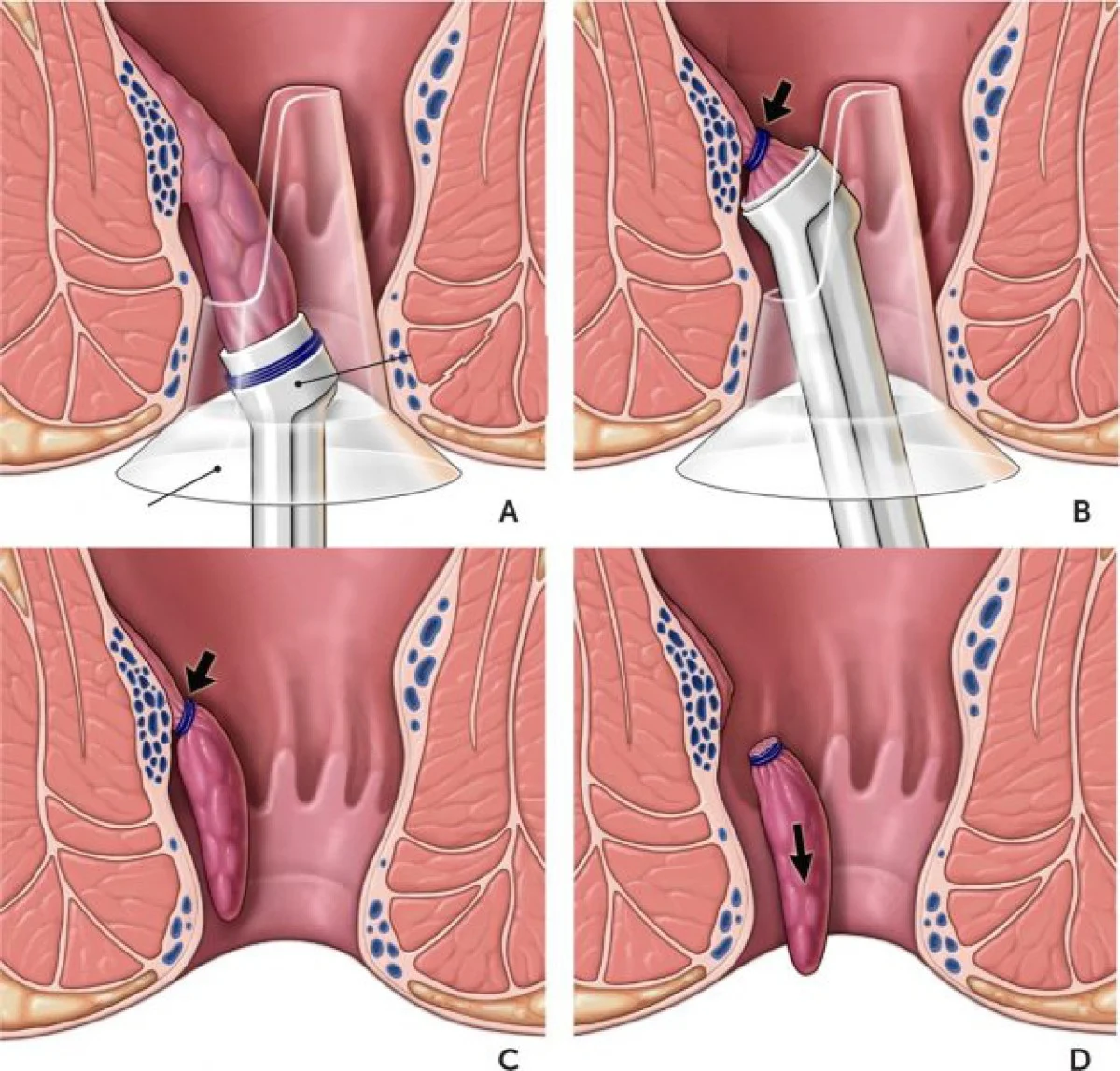2025-12-02_14-12-19_904848-meylesokhan-ir درمان بیماری های نشیمنگاه چگونه است؟