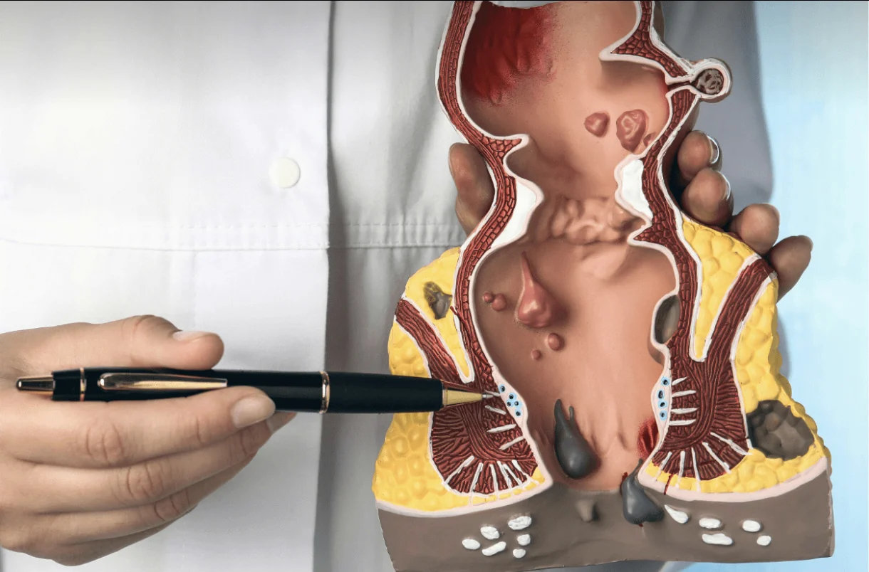 2025-12-02_14-12-20_391045-meylesokhan-ir درمان فوری بواسیر