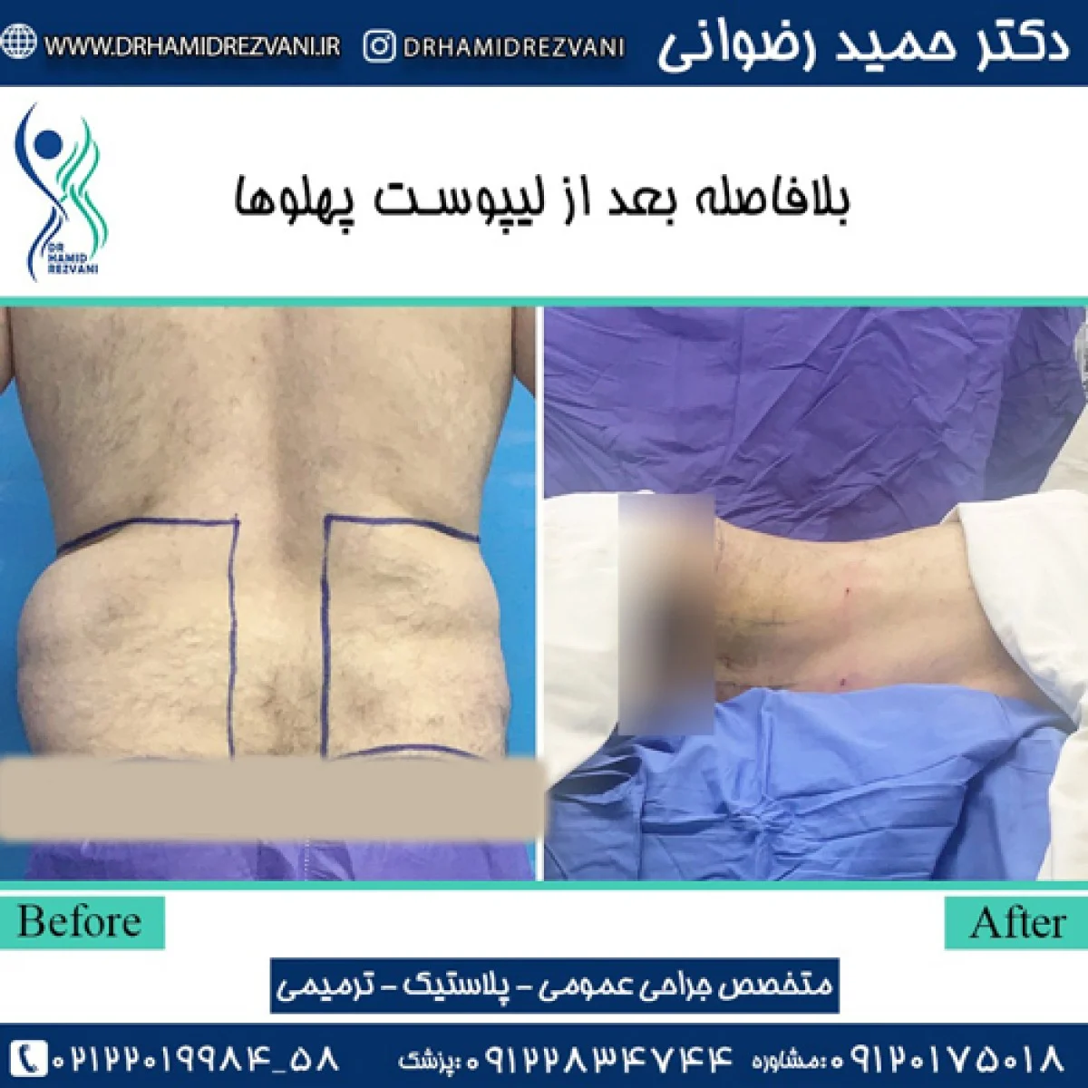 2025-12-03_20-32-15_751279-meylesokhan-ir عمل لیپوماتیک شکم و پهلو