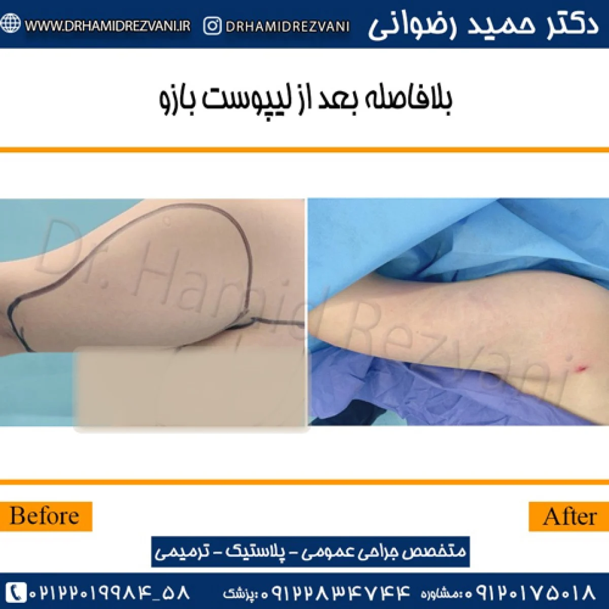 2025-12-03_20-32-16_156454-meylesokhan-ir لیپوماتیک بازو