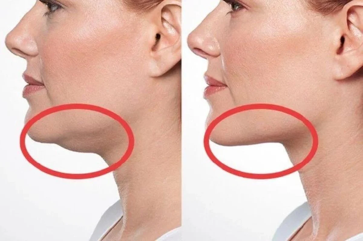 2025-12-03_20-32-16_468062-meylesokhan-ir لیپوماتیک غبغب