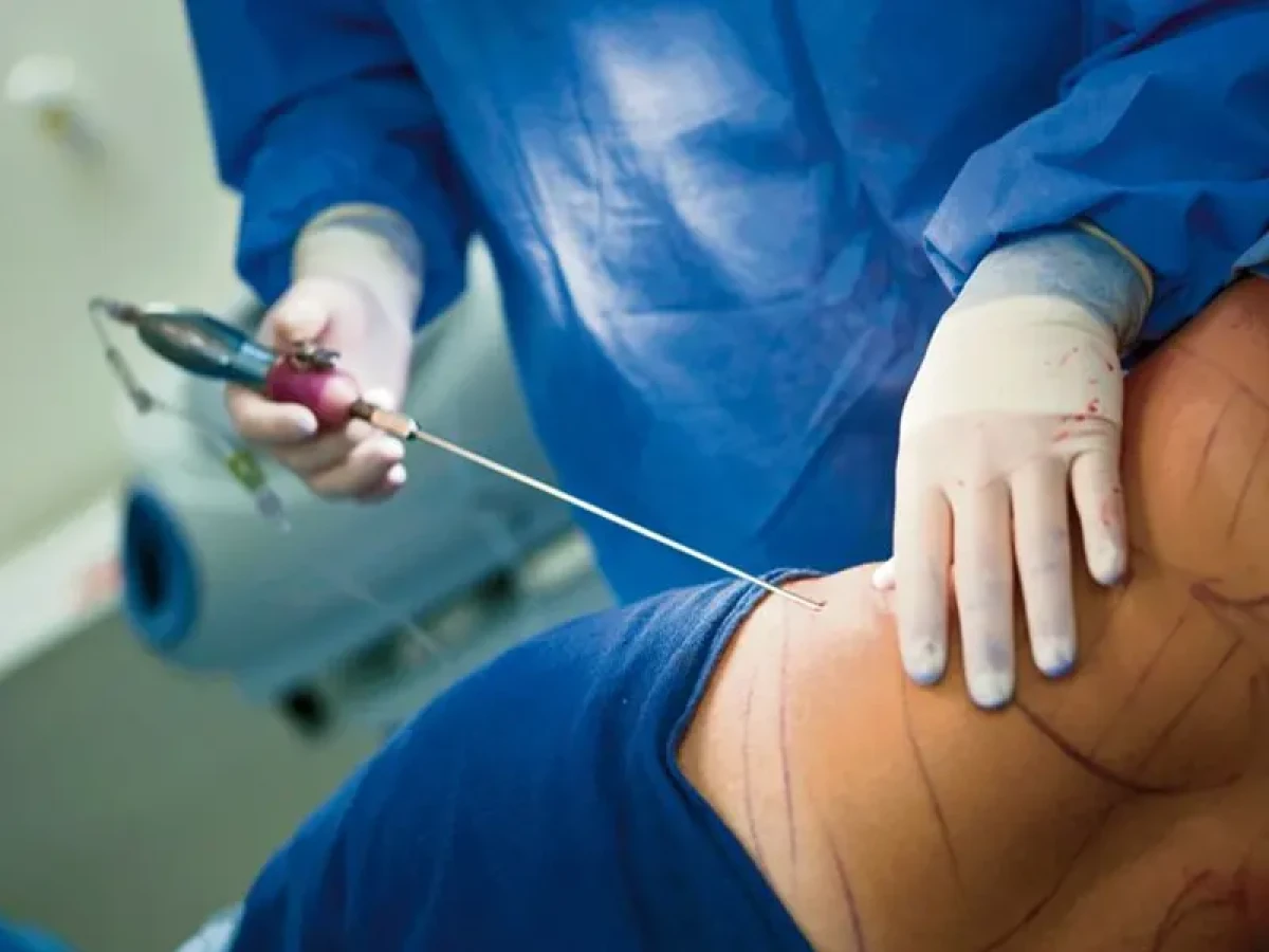 2025-12-03_20-32-17_661655-meylesokhan-ir عمل لیپوماتیک چگونه انجام میشود؟