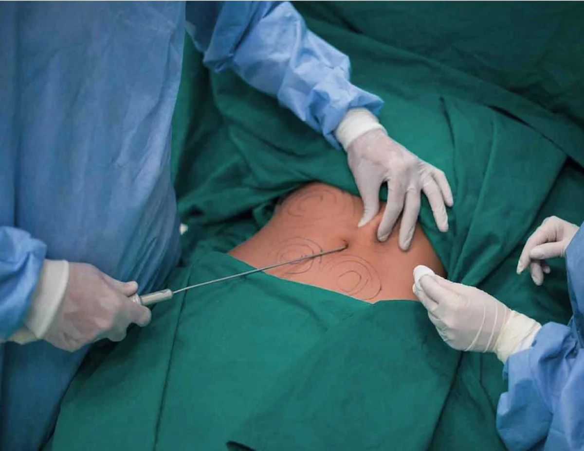 2025-12-03_20-32-18_581874-meylesokhan-ir چه کسانی برای انجام لیپوماتیک دارای محدودیت هستند؟