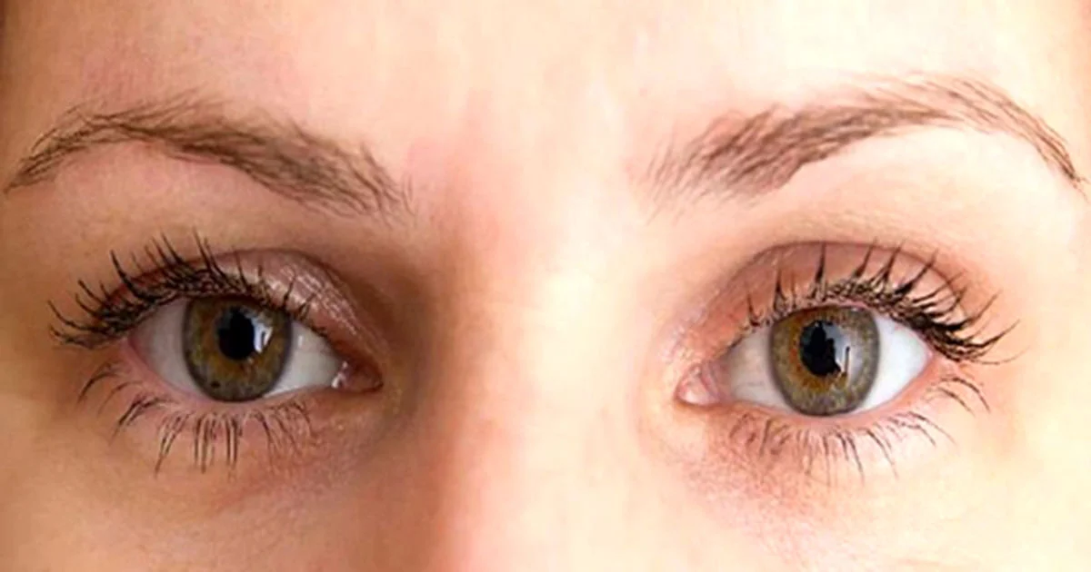 عمل جراحی پلک بالا و پایین (بلفاروپلاستی) چگونه است؟ + عکس