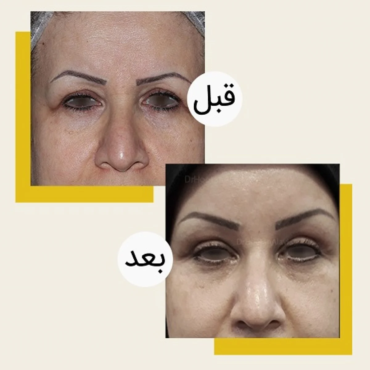 2025-12-04_08-21-28_586904-meylesokhan-ir عمل جراحی پلک بالا و پایین (بلفاروپلاستی) چگونه است؟ + عکس