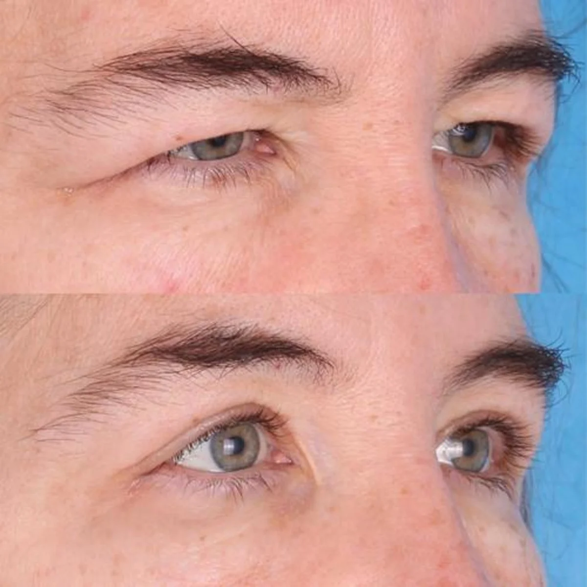 2025-12-04_08-21-28_927374-meylesokhan-ir عمل جراحی پلک بالا و پایین چه کاربردهایی دارد؟