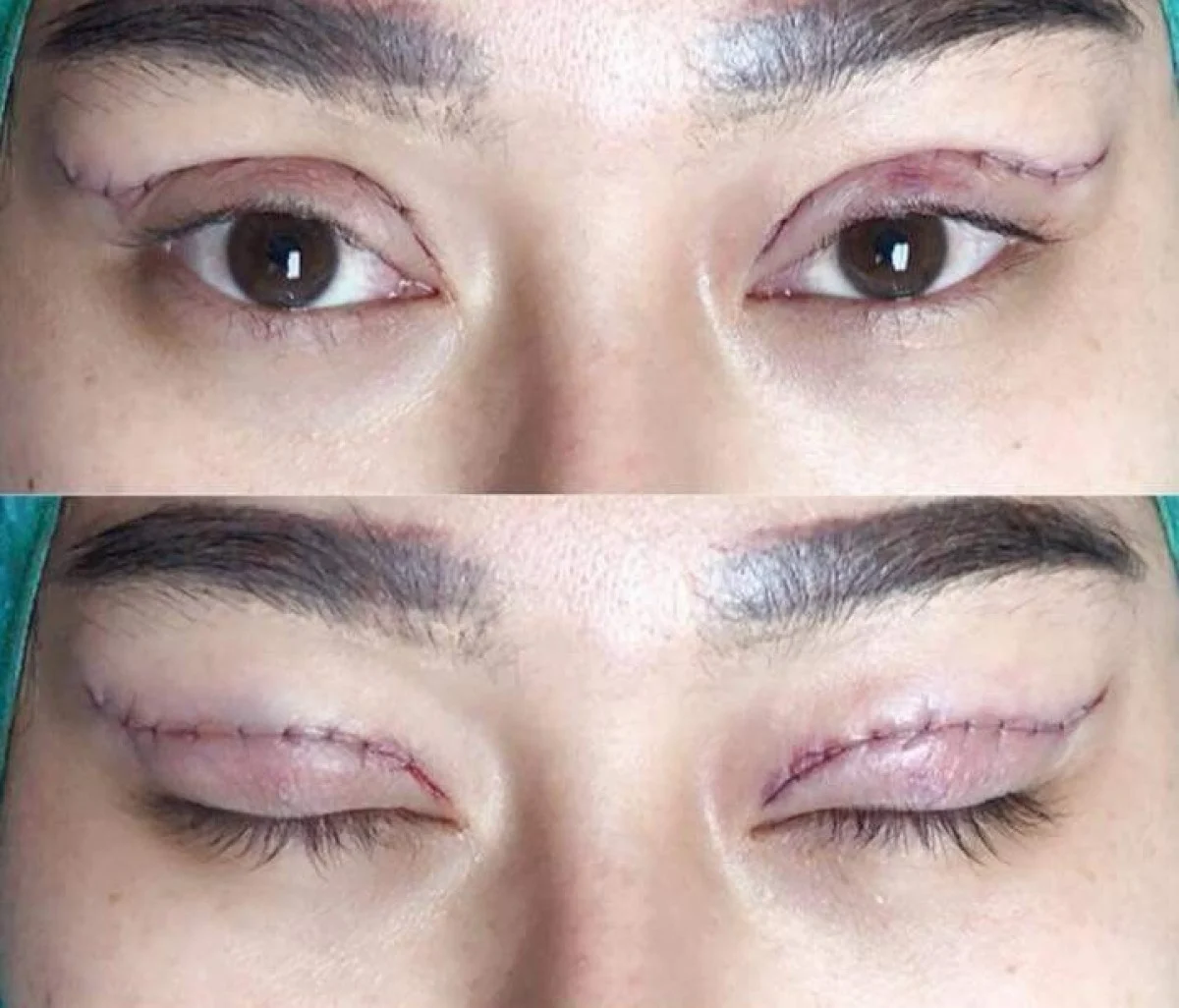 2025-12-04_08-21-29_396461-meylesokhan-ir جراحی پلک بالا و پایین (بلفاروپلاستی) چگونه انجام می شود؟