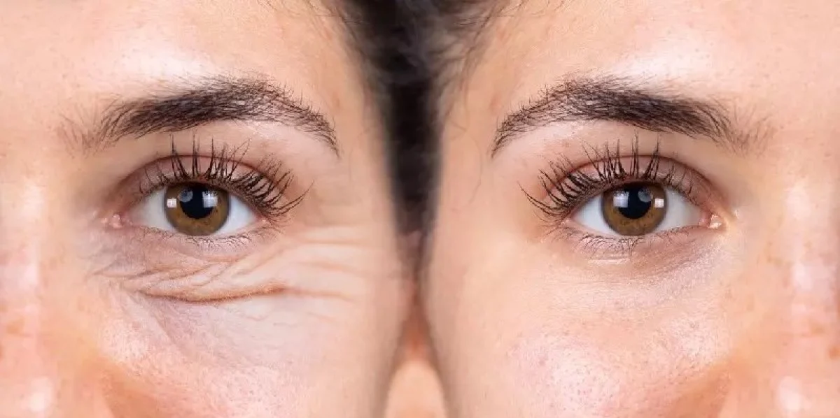 2025-12-04_08-21-29_832267-meylesokhan-ir فرآیند جراحی پلک پایین