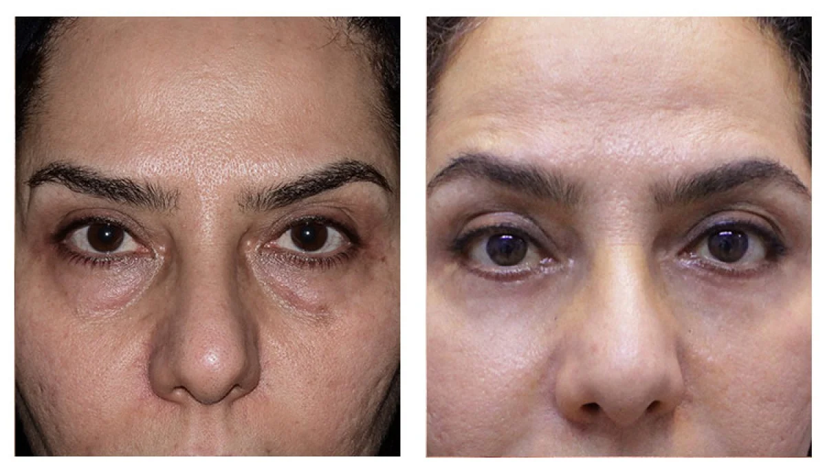 2025-12-04_08-21-30_886983-meylesokhan-ir انواع جراحی های زیبایی (بلفاروپلاستی) پلک بالا و پایین