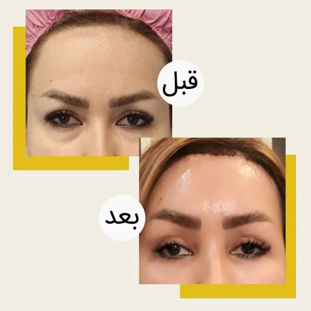 2025-12-04_08-21-31_152299-meylesokhan-ir جراحی پلک بالا