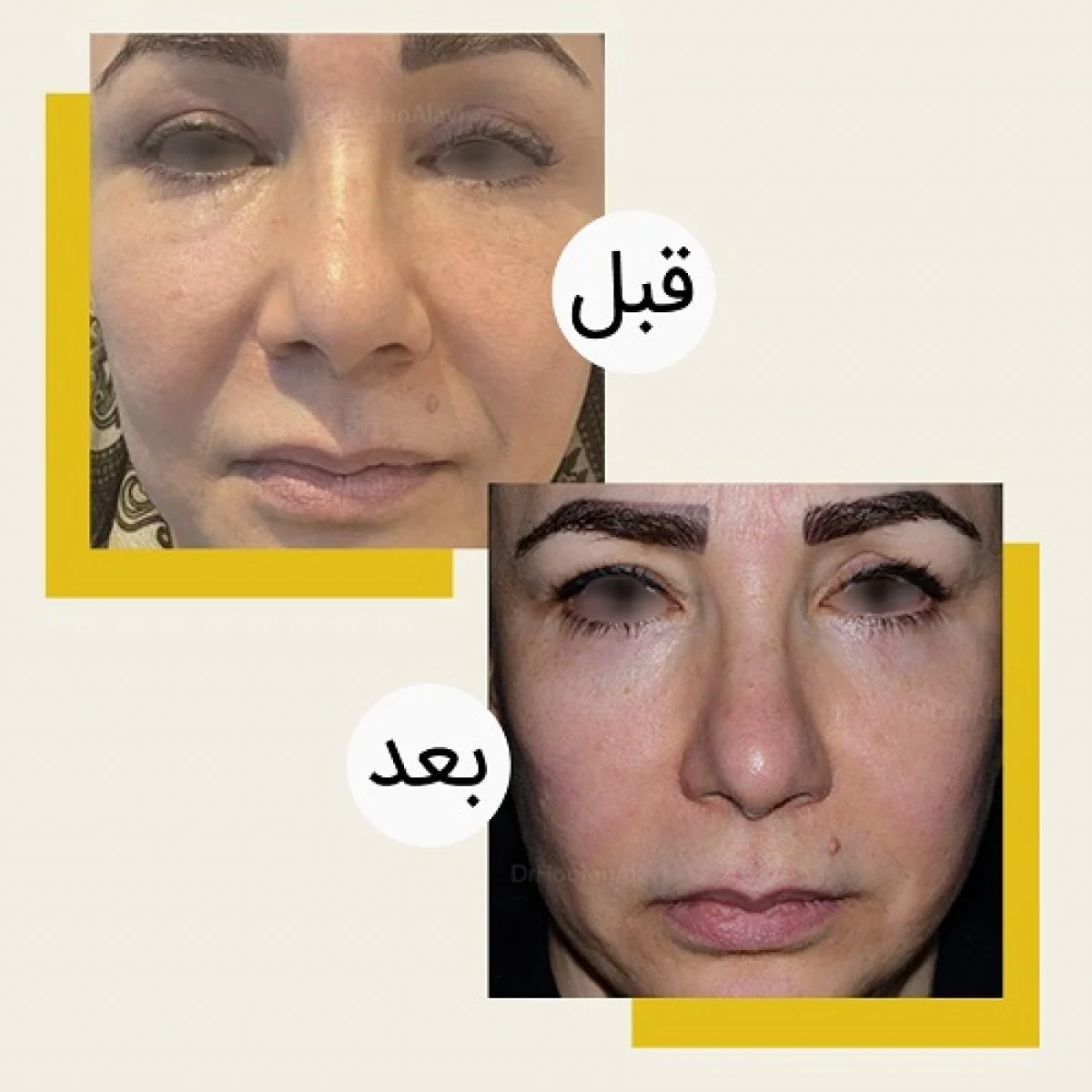 2025-12-04_08-21-31_655474-meylesokhan-ir جراحی پلک بالا و پایین برای چه کسانی مناسب نیست؟