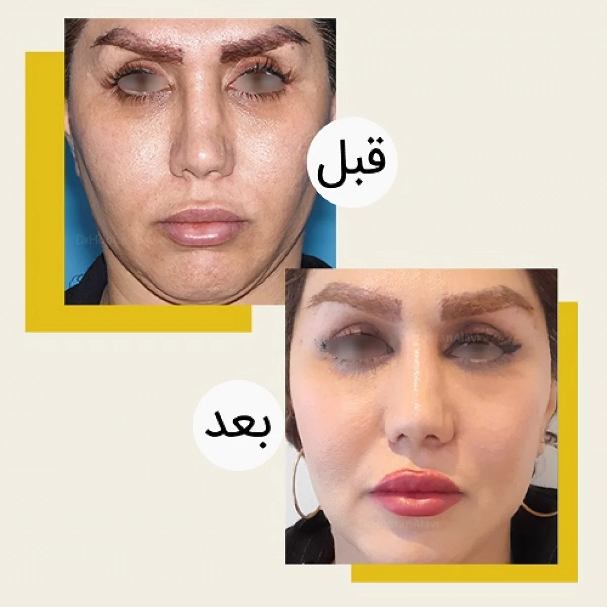 2025-12-04_08-21-31_918065-meylesokhan-ir مقایسه جراحی پلک بالا و پلک پایین