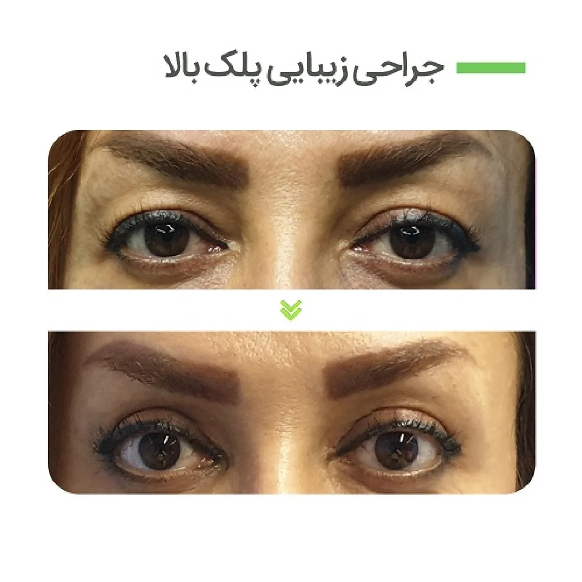 2025-12-04_08-21-32_442593-meylesokhan-ir عوارض جراحی پلک بالا و پائین