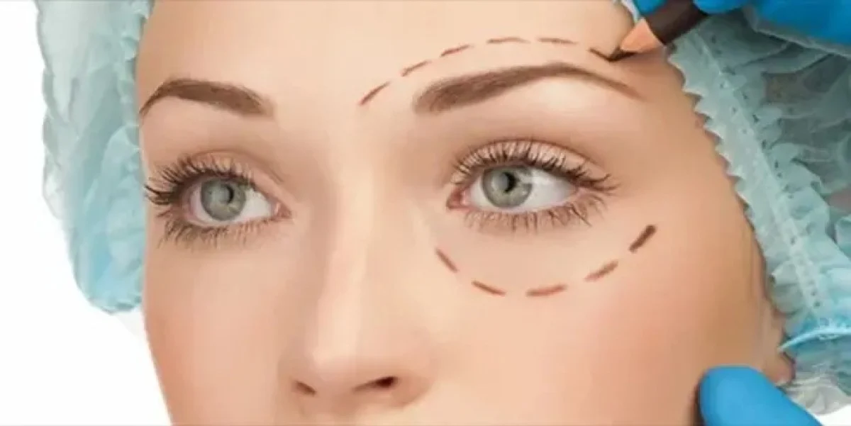 2025-12-04_08-21-32_744178-meylesokhan-ir هزینه عمل بلفاروپلاستی پلک بالا و پایین چقدر است؟