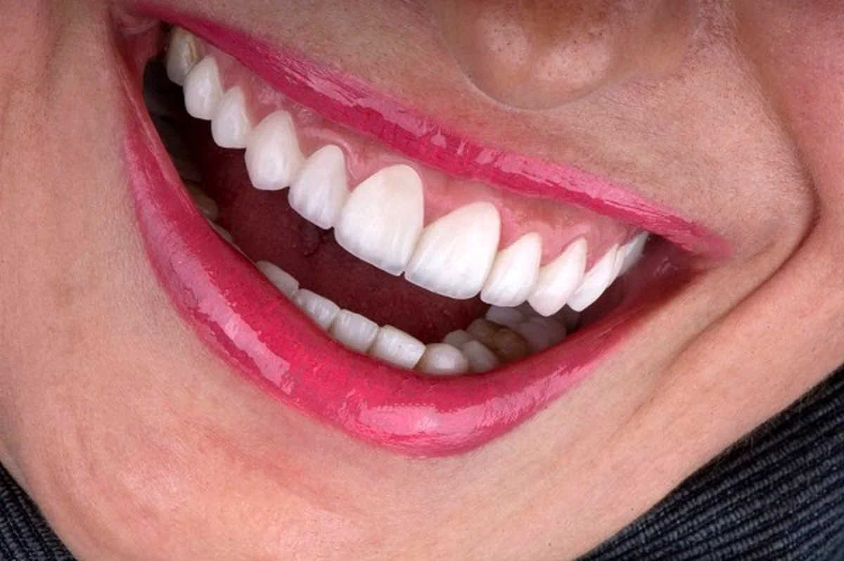 لمینت دندان اقساطی +شرایط پیش پرداخت و قسط چیست؟