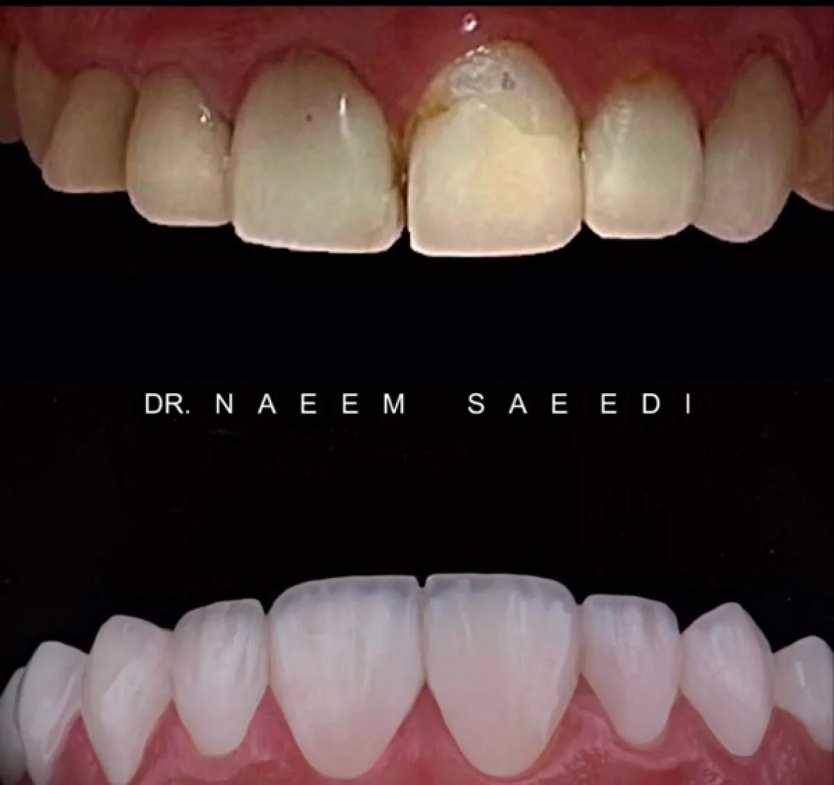 2025-12-04_08-26-15_911693-meylesokhan-ir هزینه انواع لمینت دندان در تهران