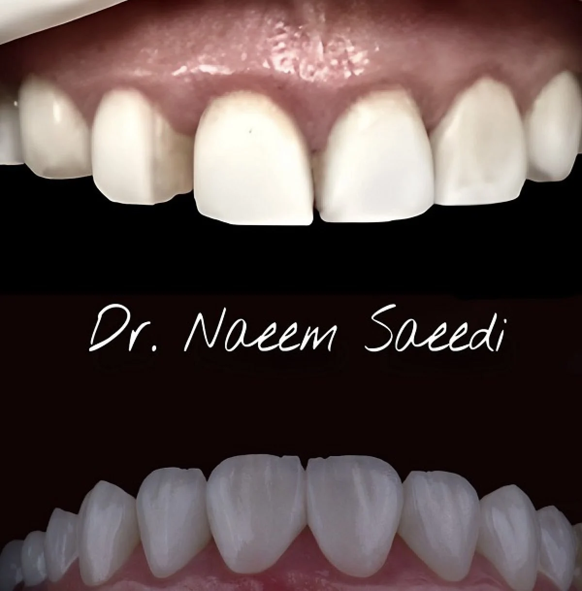 2025-12-04_08-26-16_230971-meylesokhan-ir مزایای لمینت دندان اقساطی