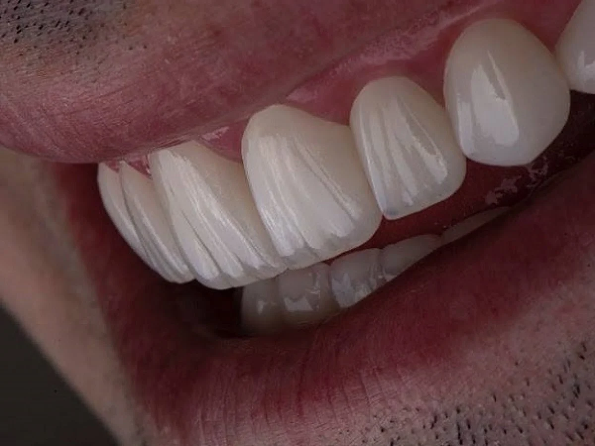 2025-12-04_08-26-16_619959-meylesokhan-ir شرایط اقساط لمینت دندان چگونه است؟