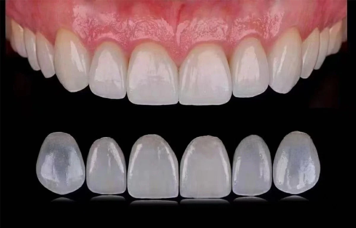 2025-12-04_08-26-16_934085-meylesokhan-ir مراحل لمینت دندان به صورت اقساطی