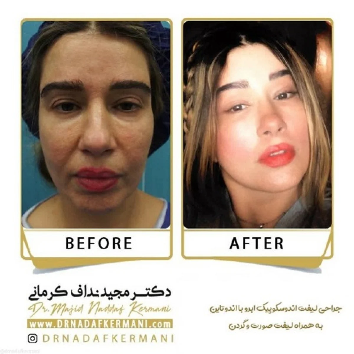 2025-12-04_17-26-44_316516-meylesokhan-ir انواع لیفت صورت | بررسی روشهای مختلف لیفت صورت