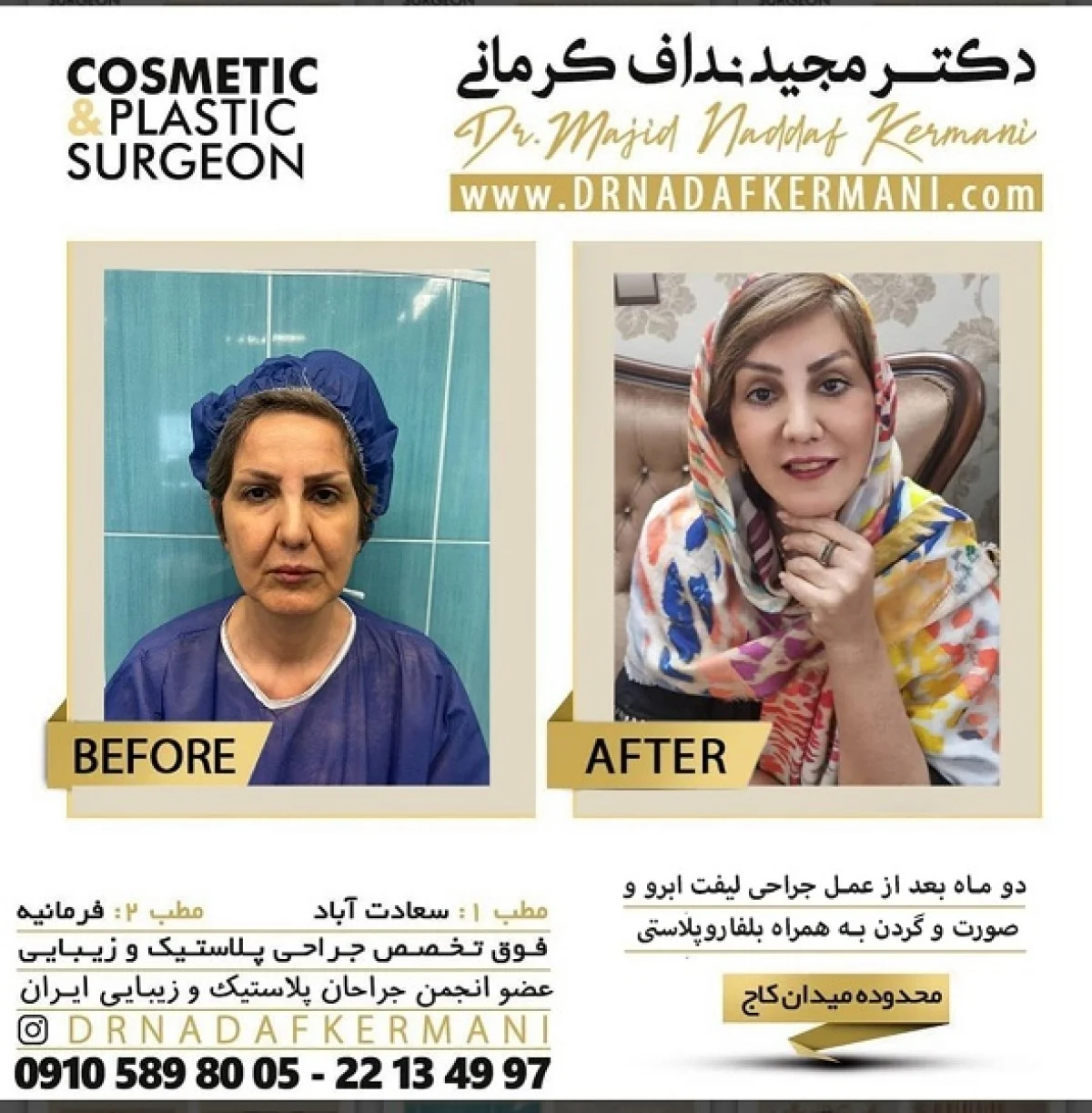 2025-12-04_17-26-44_701155-meylesokhan-ir لیفت صورت چیست؟