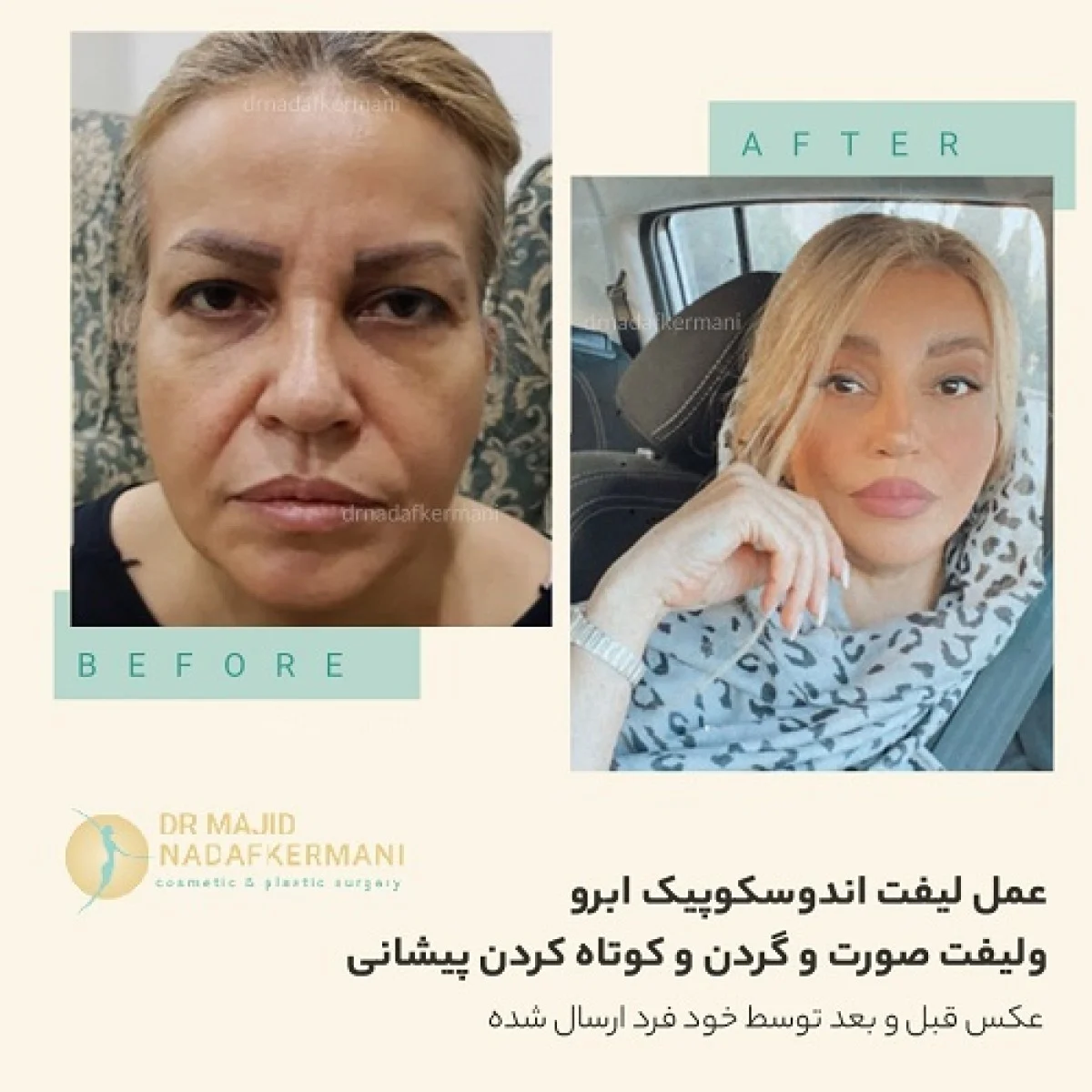 2025-12-04_17-26-45_805821-meylesokhan-ir عمل لیفت اندوسکوپیک ابرو و لیفت صورت