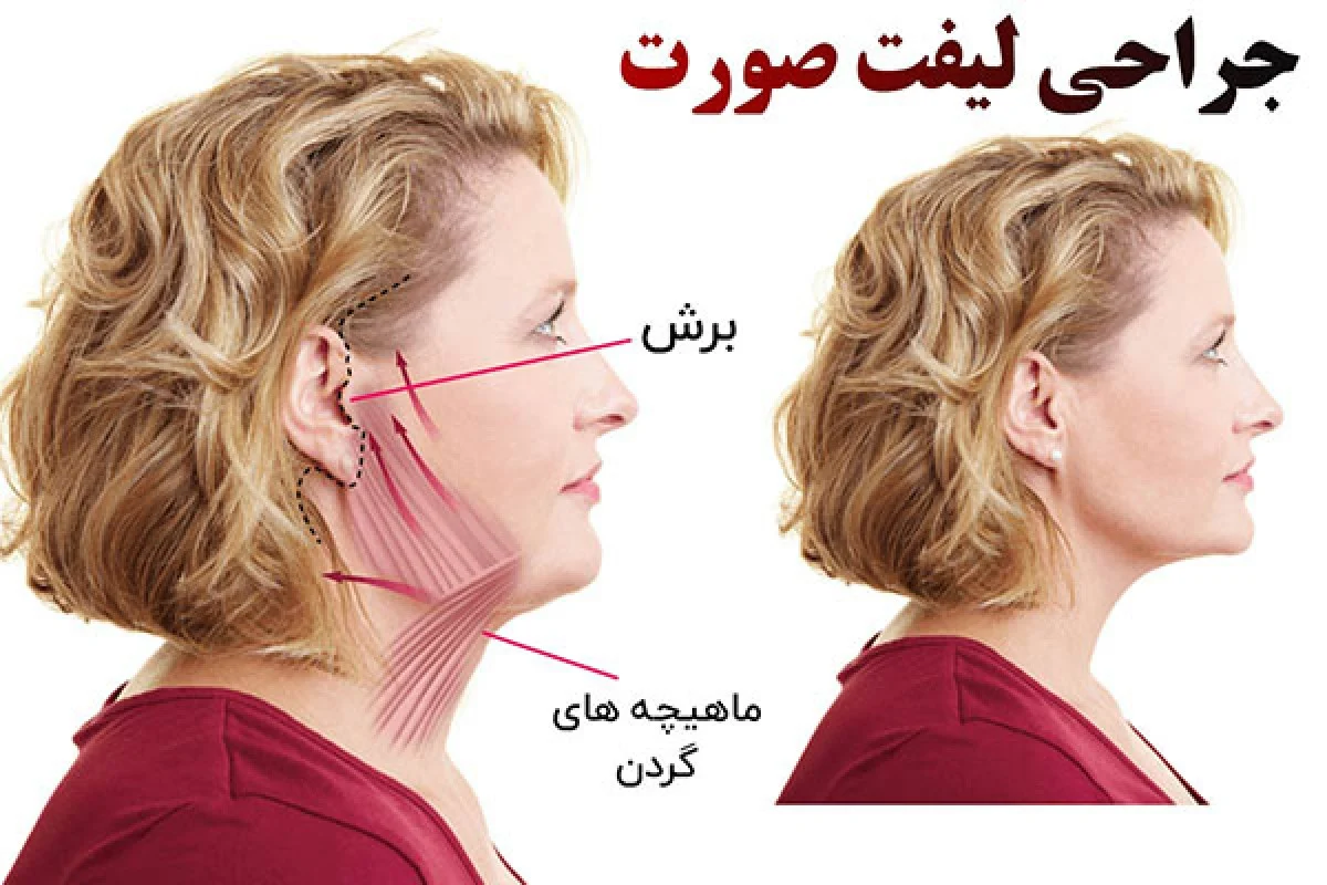 2025-12-04_17-26-46_456261-meylesokhan-ir لیفت صورت با جراحی
