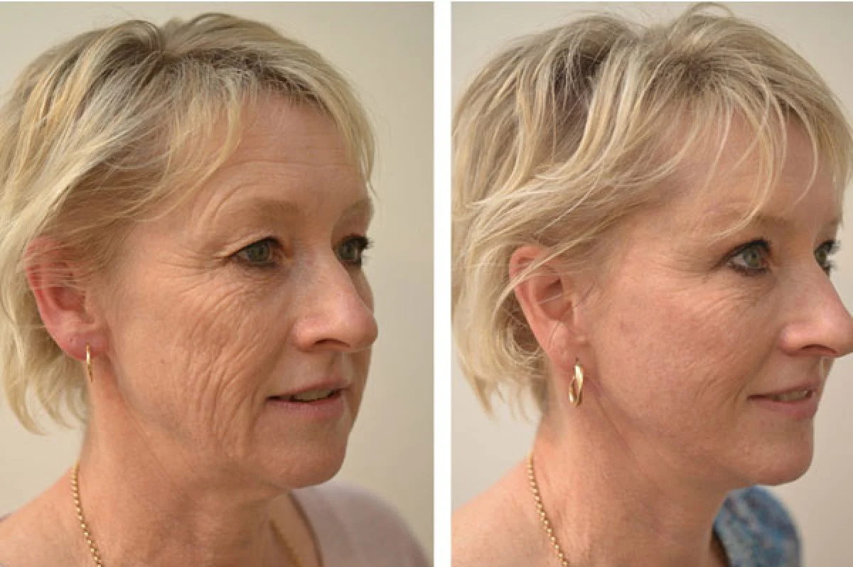 2025-12-04_17-26-46_668877-meylesokhan-ir لیفت صورت با بوتاکس