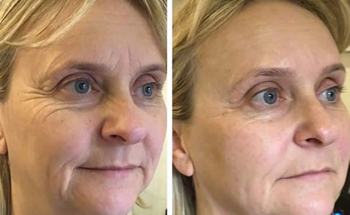 2025-12-04_17-26-46_888332-meylesokhan-ir لیفت صورت با هایفوتراپی