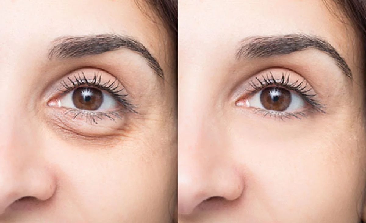 2025-12-04_17-26-47_082532-meylesokhan-ir لیفت صورت با کربوکسی تراپی