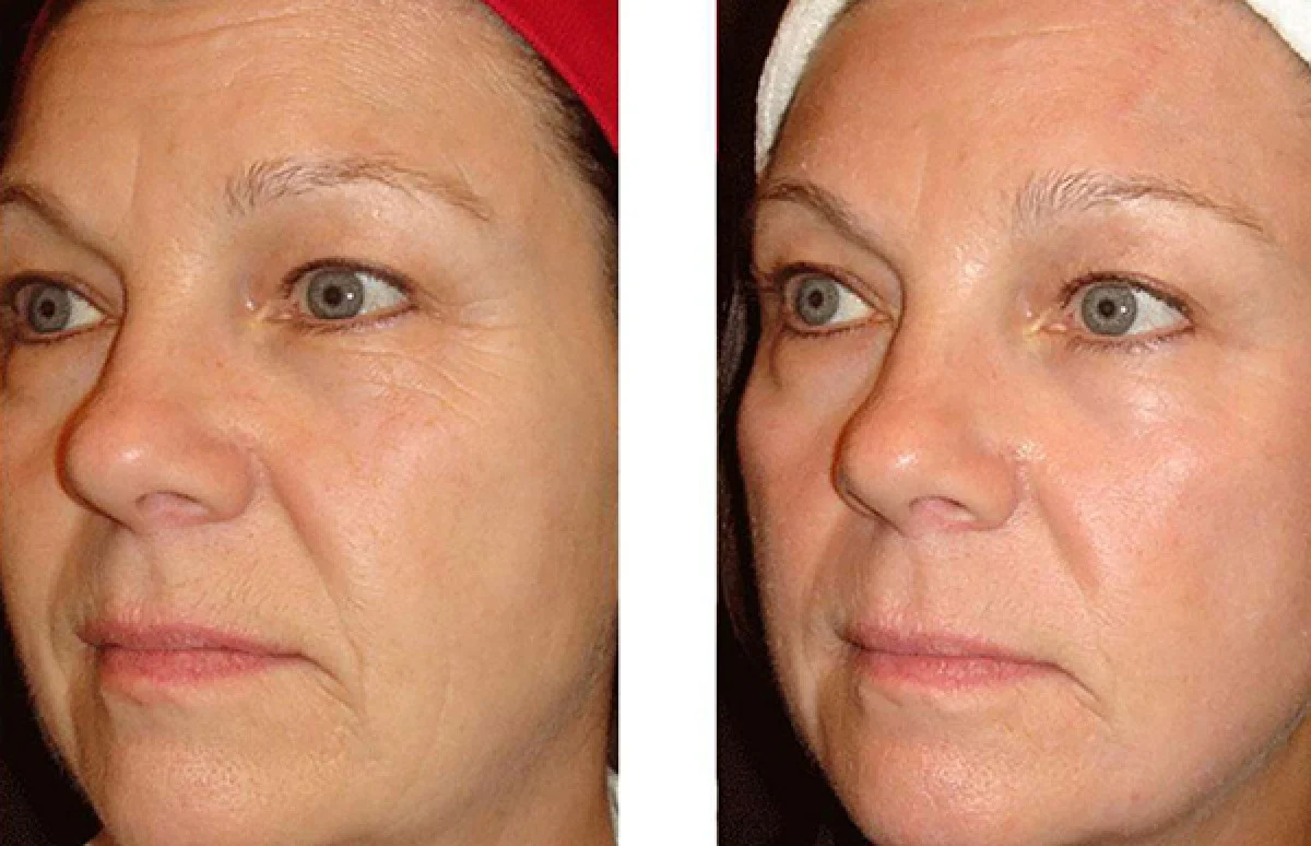 2025-12-04_17-26-47_300762-meylesokhan-ir لیفت صورت با میکرونیدلینگ