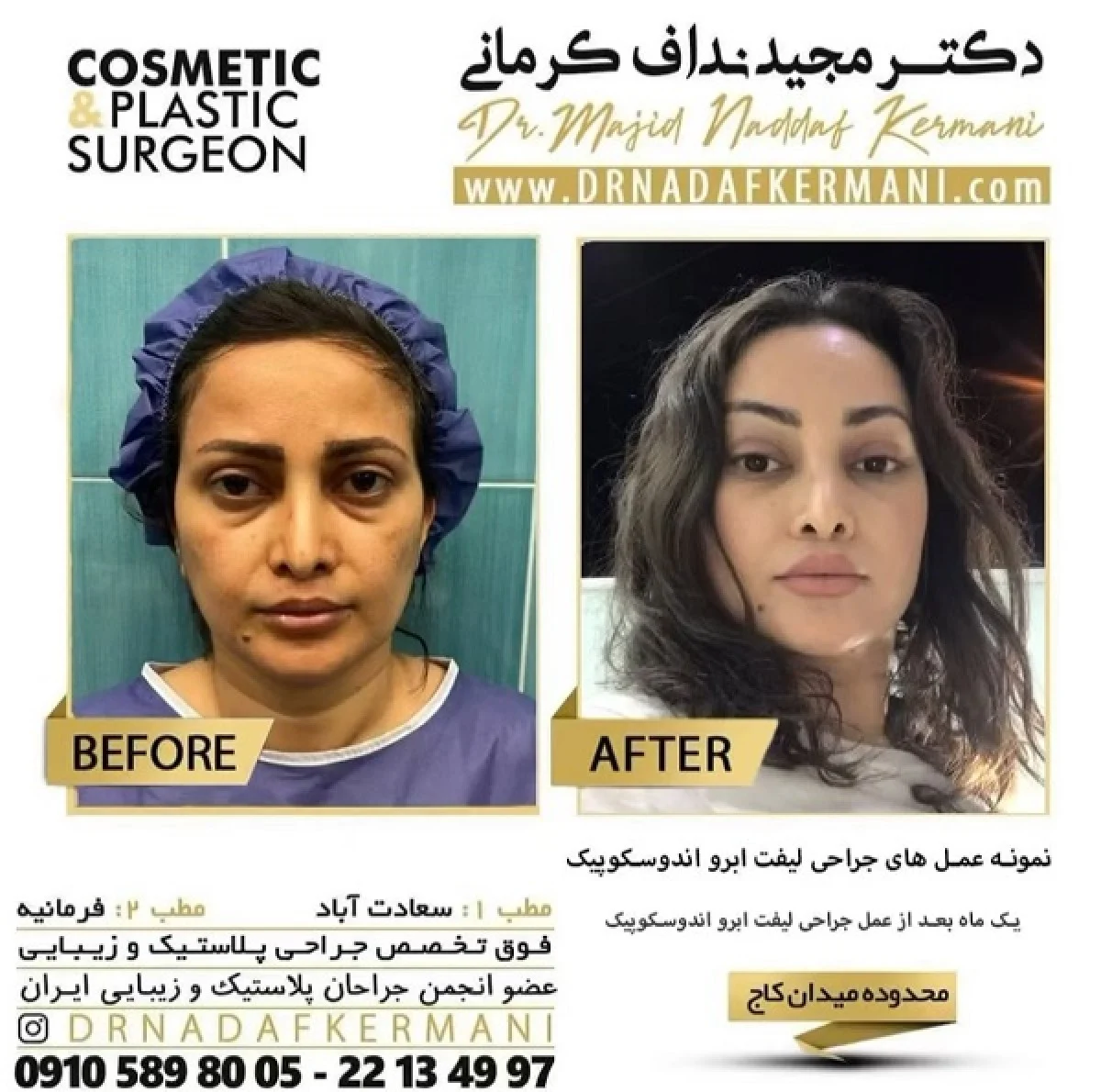 2025-12-04_17-26-47_527935-meylesokhan-ir انواع لیفت صورت